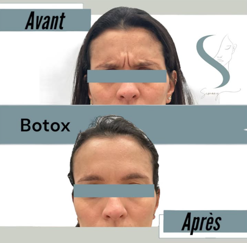 Avant et après — résultat 1