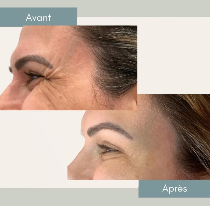 Avant et après — résultat 2