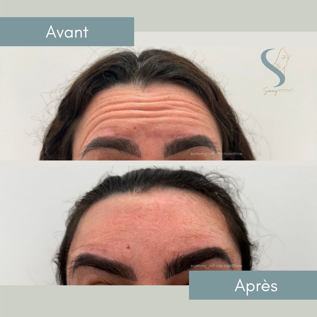 Avant et après — résultat 4